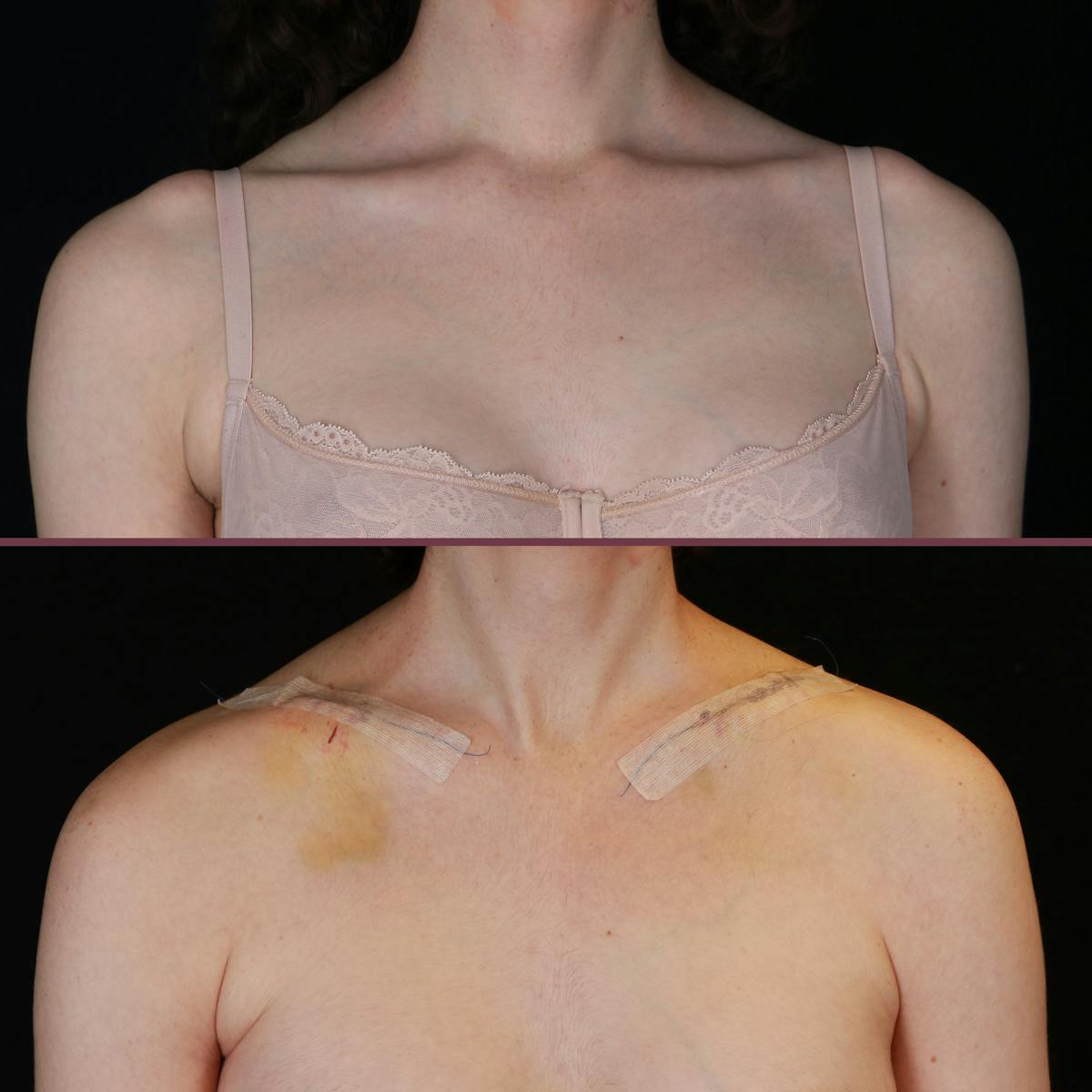 Clavicle Shortening Before & After Gallery - Patient 304254 - Image 1