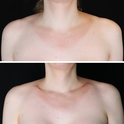 Clavicle Shortening Before & After Gallery - Patient 392164 - Image 1