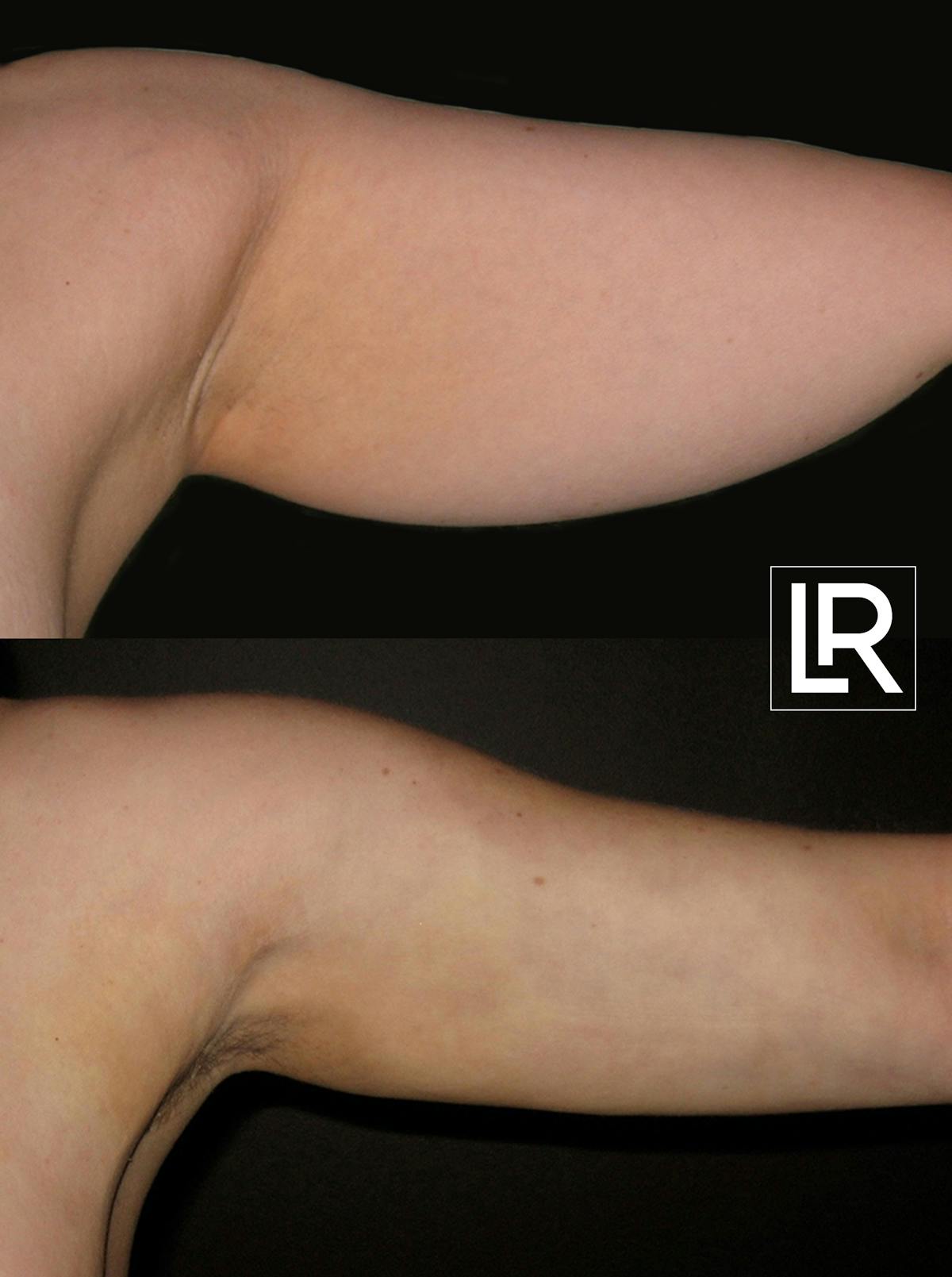 Arm Lift Before & After Gallery - Patient 412184 - Image 1