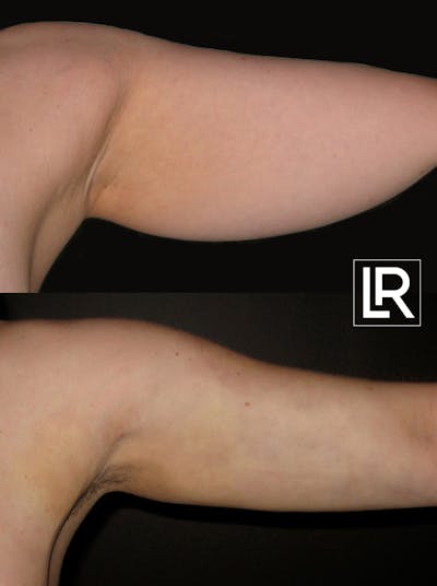 Arm Lift Before & After Gallery - Patient 412184 - Image 1