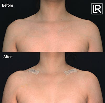 Clavicle Shortening Before & After Gallery - Patient 271330 - Image 1