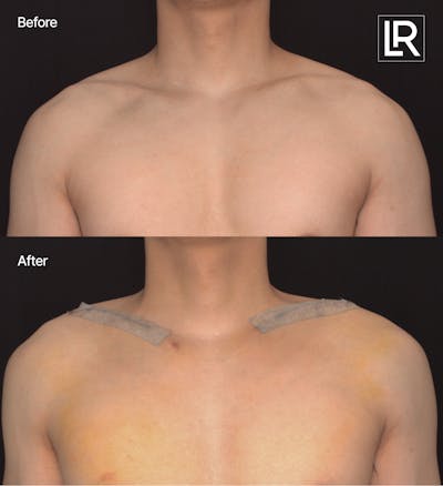 Clavicle Shortening Before & After Gallery - Patient 948536 - Image 1
