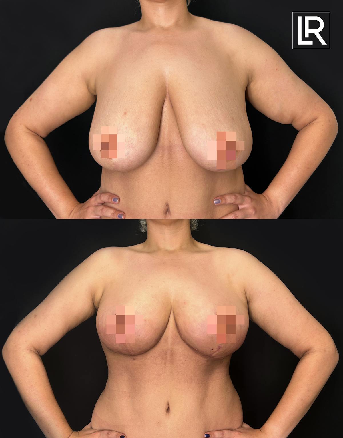 Arm Lift Before & After Gallery - Patient 412184 - Image 3