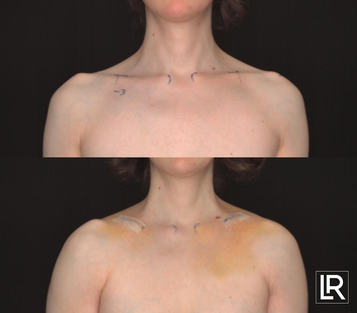 Clavicle Shortening Before & After Gallery - Patient 524499 - Image 1