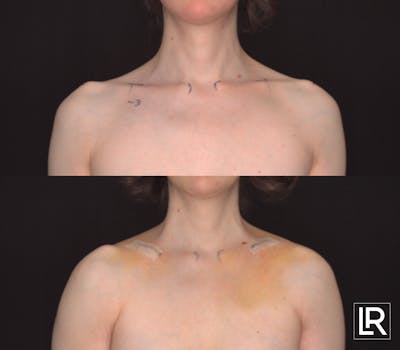 Clavicle Shortening Before & After Gallery - Patient 524499 - Image 1