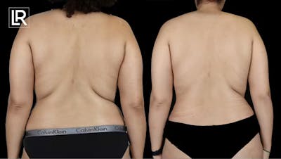 Body Lift Before & After Gallery - Patient 250445 - Image 1