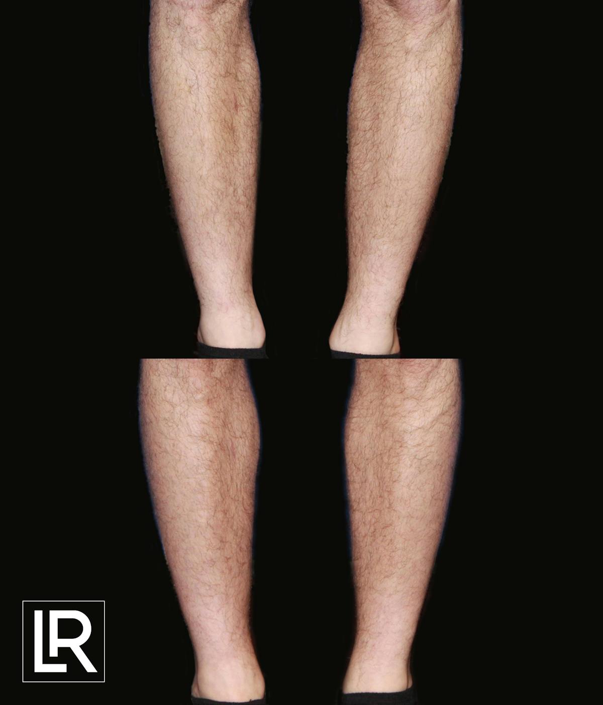 Calf Augmentation Before & After Gallery - Patient 201227 - Image 1