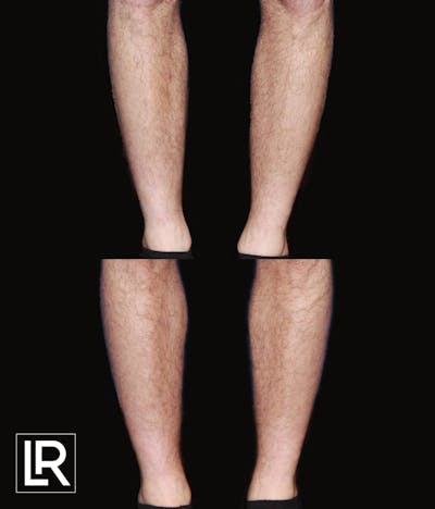 Calf Augmentation Before & After Gallery - Patient 201227 - Image 1