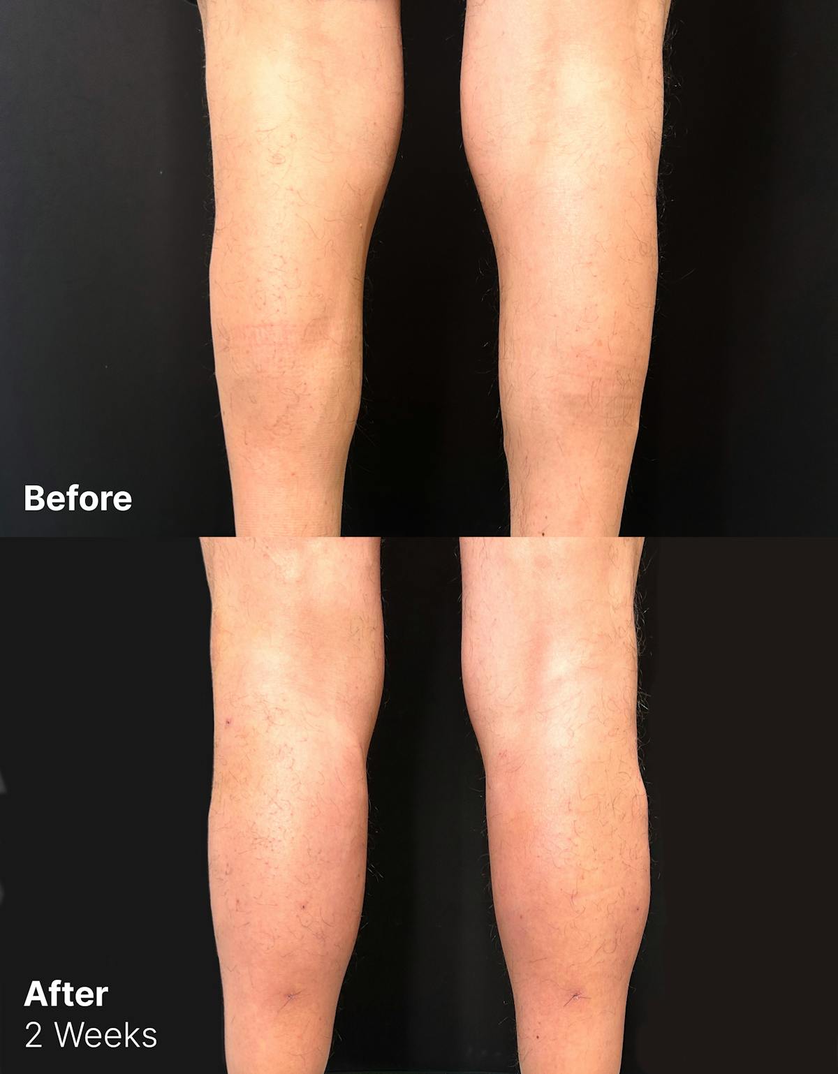 Calf Augmentation Before & After Gallery - Patient 312178 - Image 1