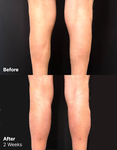 Calf Augmentation Before & After Gallery - Patient 312178 - Image 1