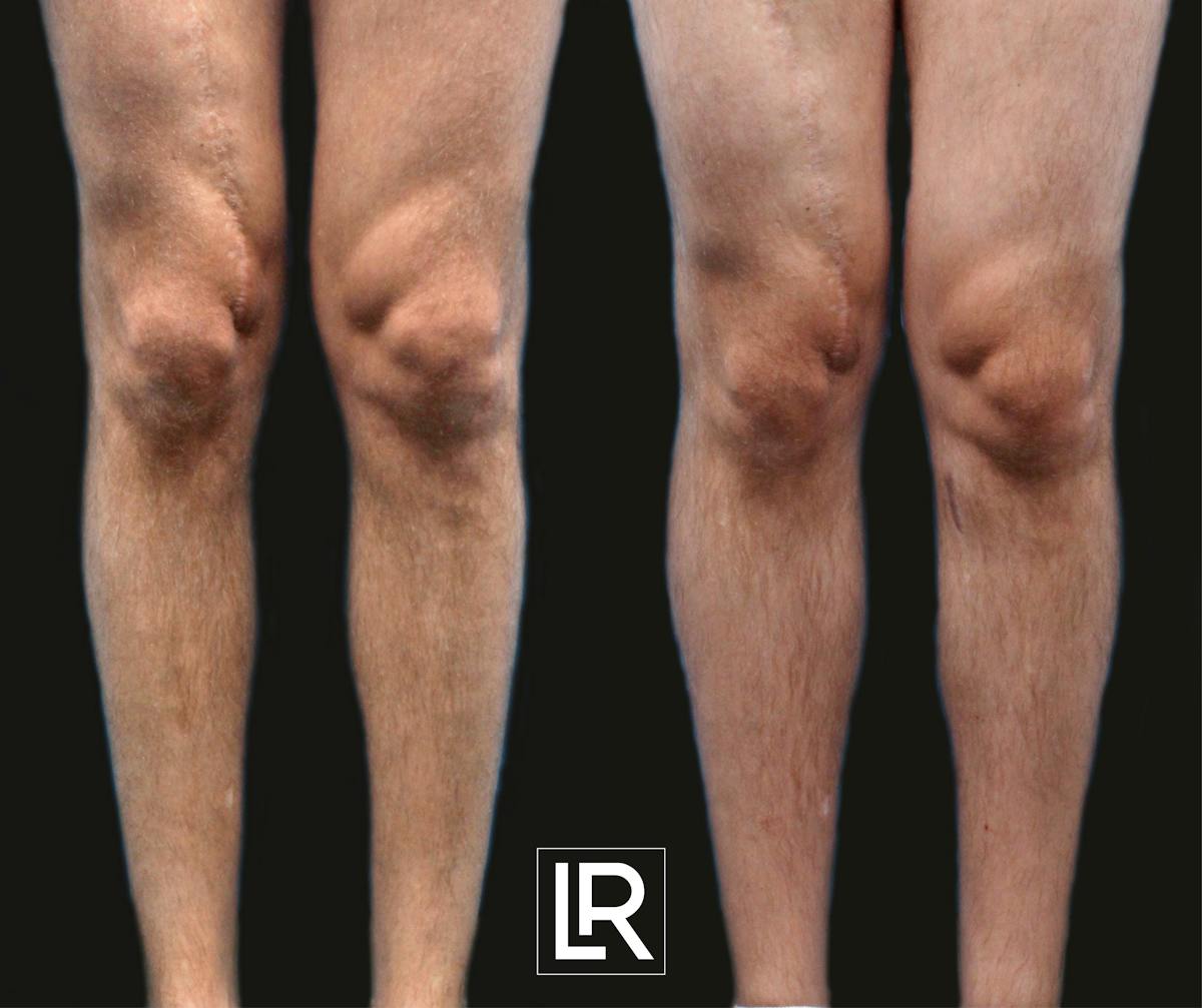 Calf Augmentation Before & After Gallery - Patient 392342 - Image 1