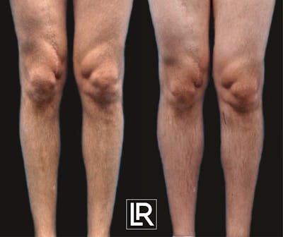 Calf Augmentation Before & After Gallery - Patient 392342 - Image 1