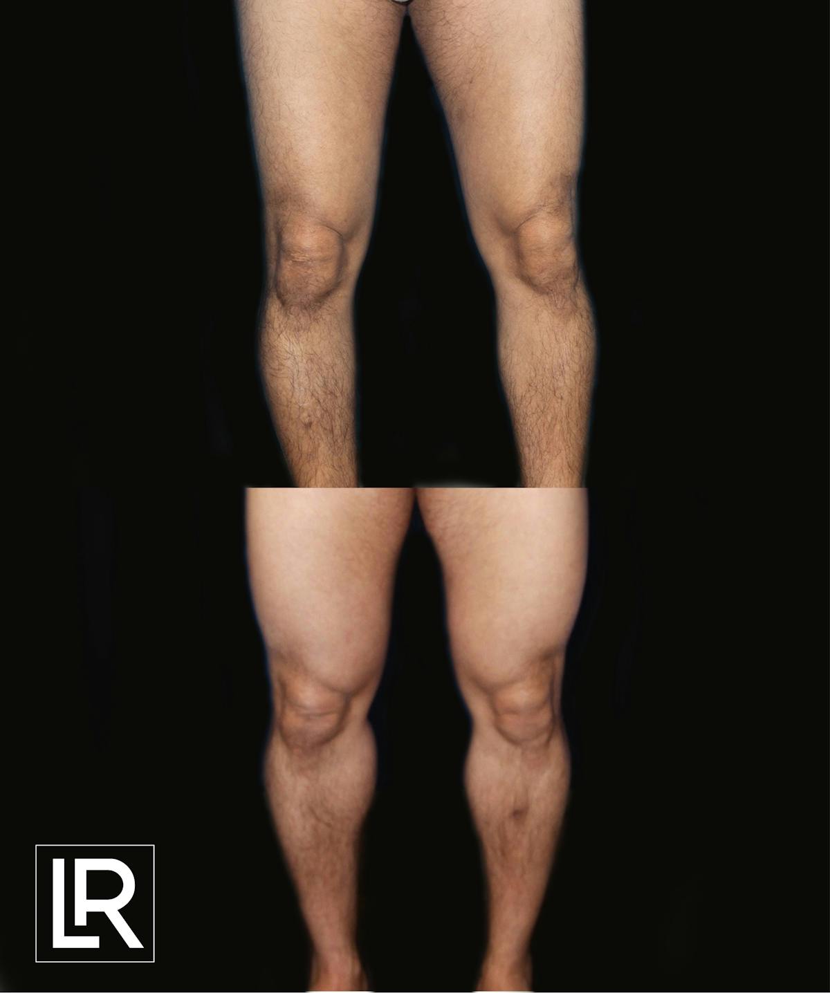 Calf Augmentation Before & After Gallery - Patient 350158 - Image 1