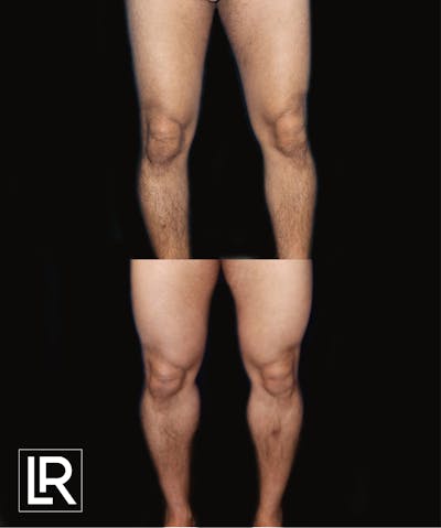 Calf Augmentation Before & After Gallery - Patient 350158 - Image 1