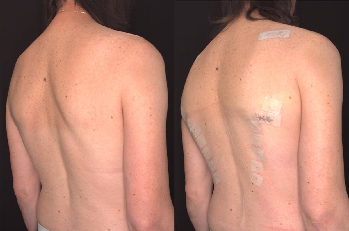 Scapula Shave Before & After Gallery - Patient 385295 - Image 1