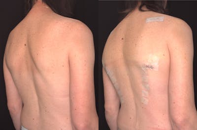 Scapula Shave Before & After Gallery - Patient 385295 - Image 1
