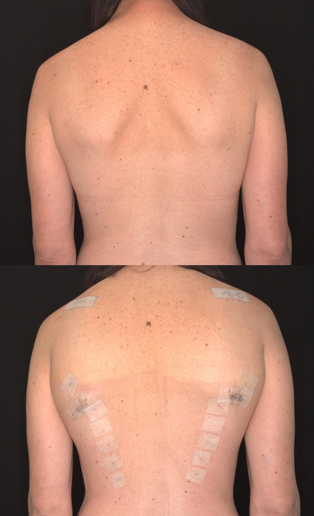 Scapula Shave Before & After Gallery - Patient 385295 - Image 2