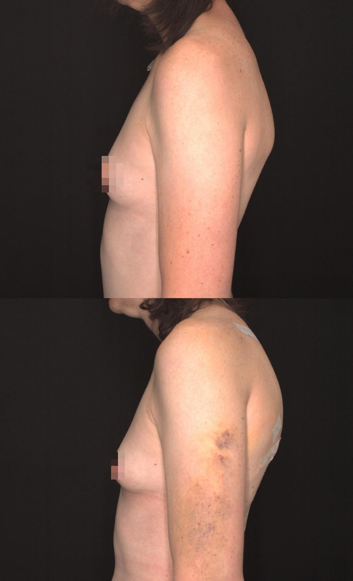 Scapula Shave Before & After Gallery - Patient 385295 - Image 3