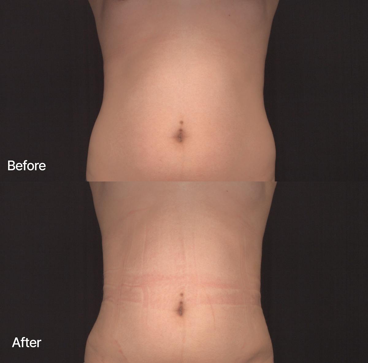 Rib Remodeling Before & After Gallery - Patient 547751 - Image 1