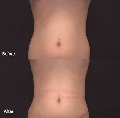 Rib Remodeling Before & After Gallery - Patient 547751 - Image 1