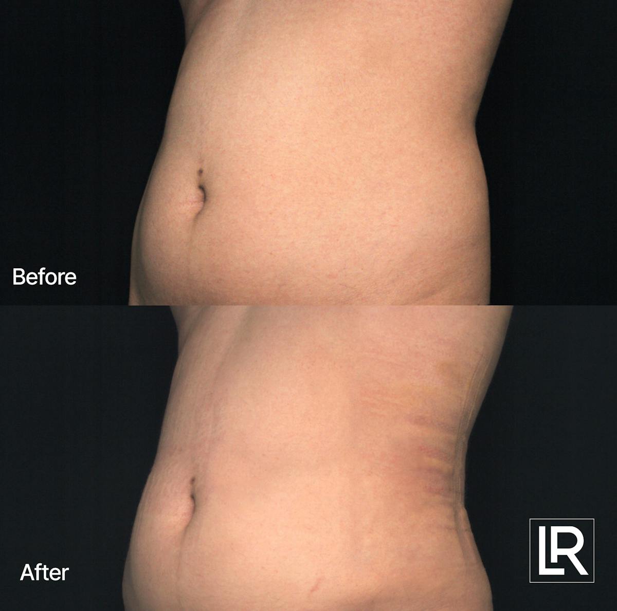 Rib Remodeling Before & After Gallery - Patient 380662 - Image 1