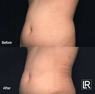 Rib Remodeling Before & After Gallery - Patient 380662 - Image 1