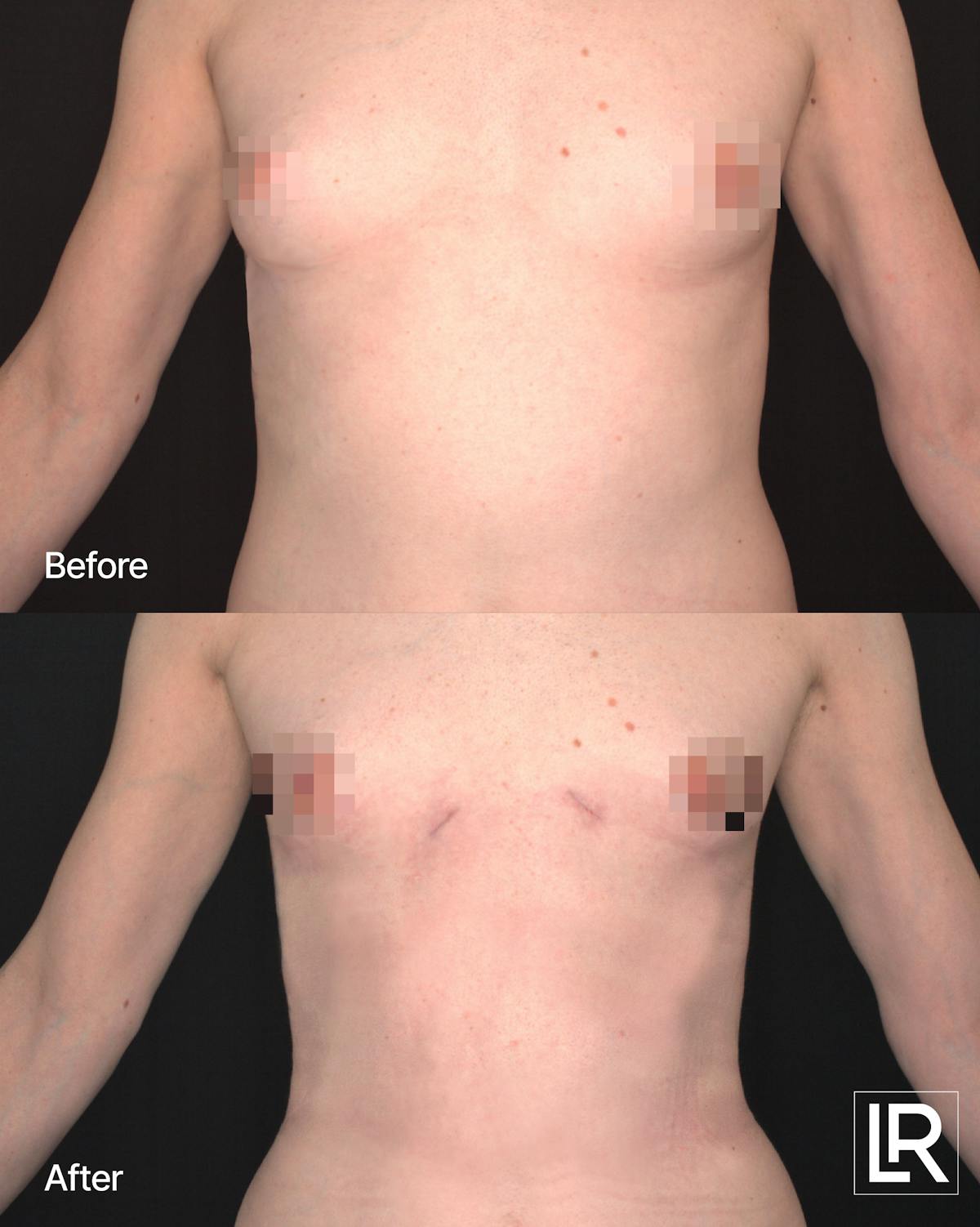 Rib Remodeling Before & After Gallery - Patient 297064 - Image 1