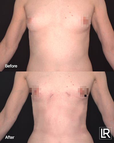 Rib Remodeling Before & After Gallery - Patient 297064 - Image 1