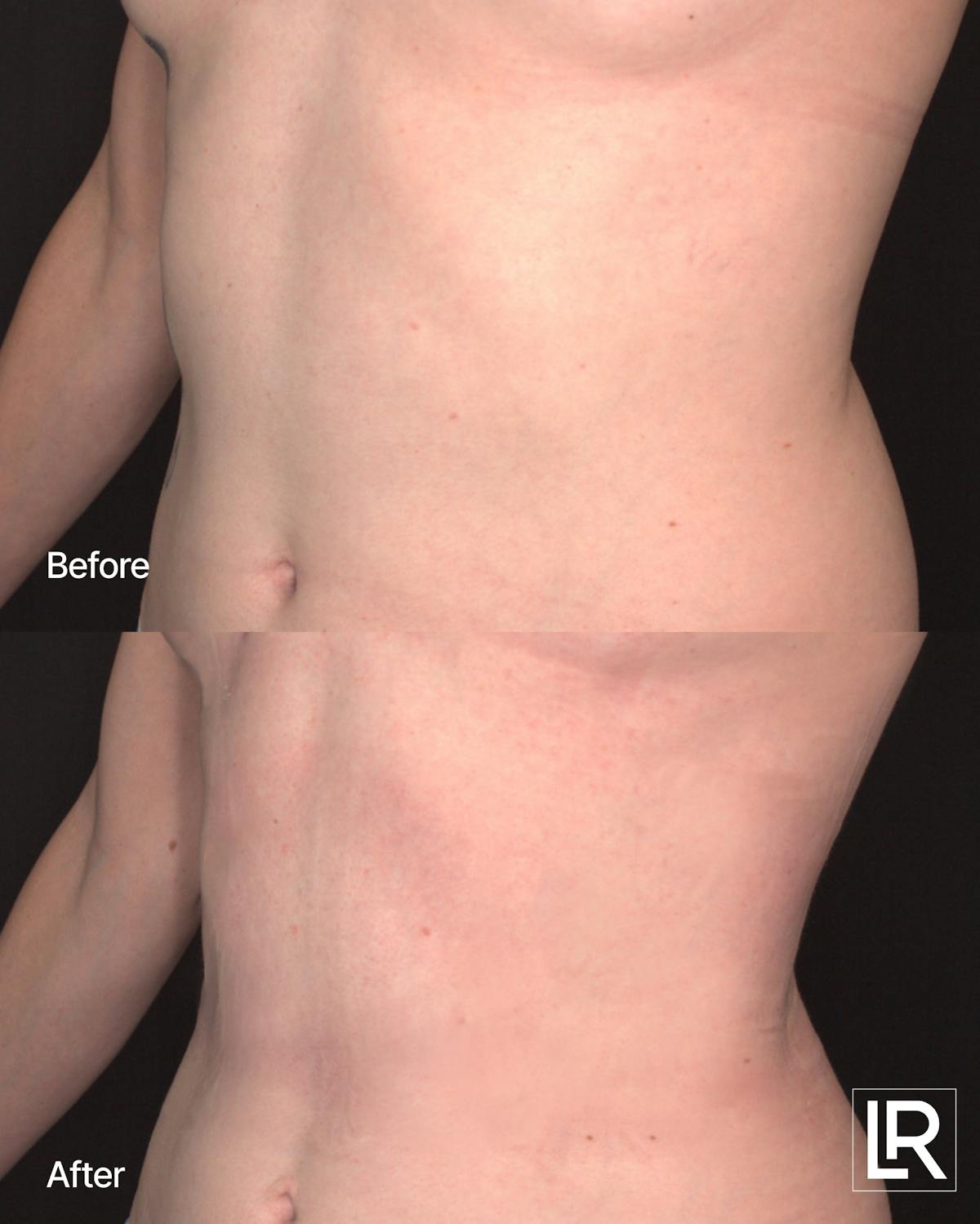 Rib Remodeling Before & After Gallery - Patient 172296 - Image 2