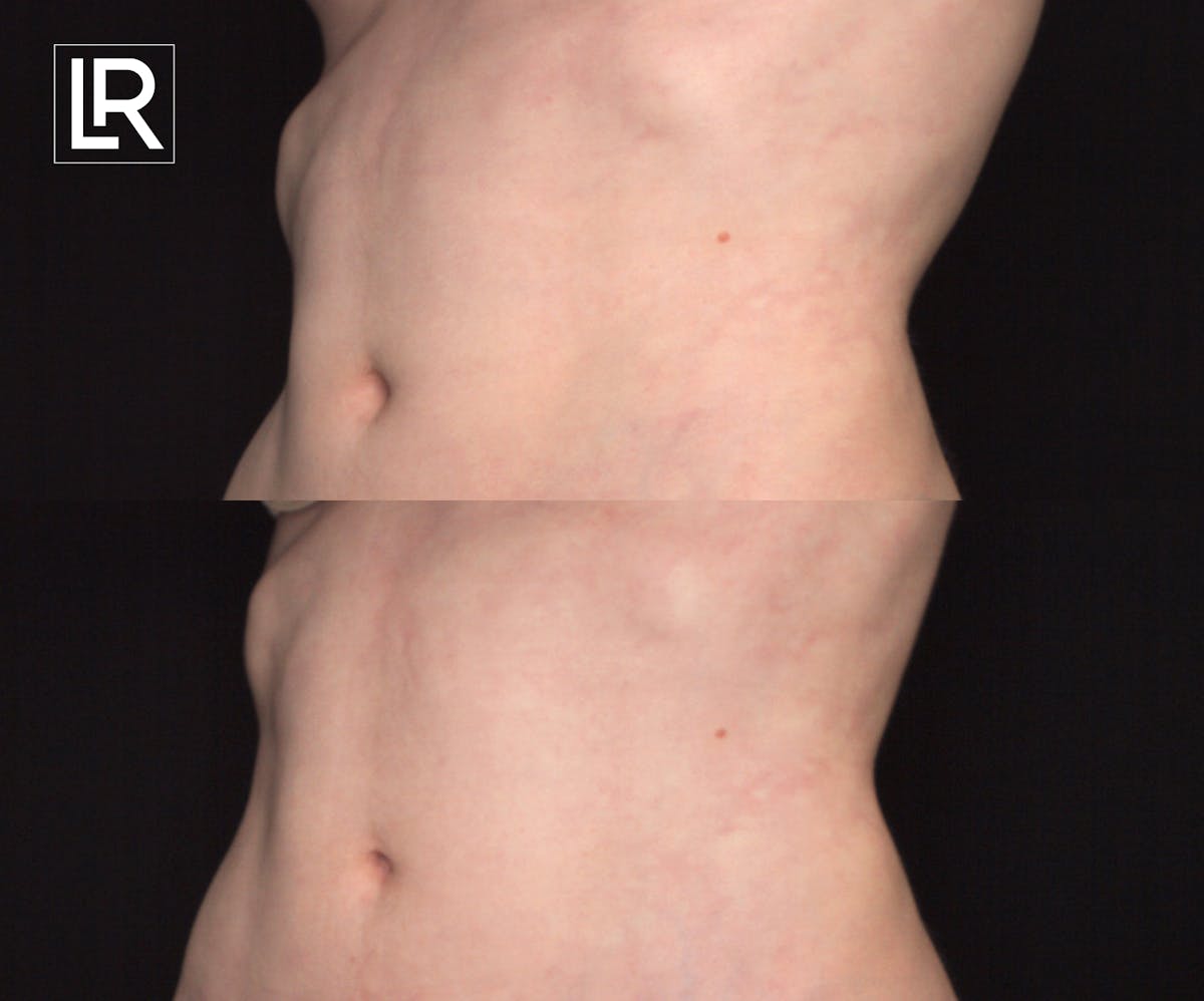 Rib Remodeling Before & After Gallery - Patient 170271 - Image 1