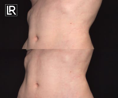 Rib Remodeling Before & After Gallery - Patient 170271 - Image 1