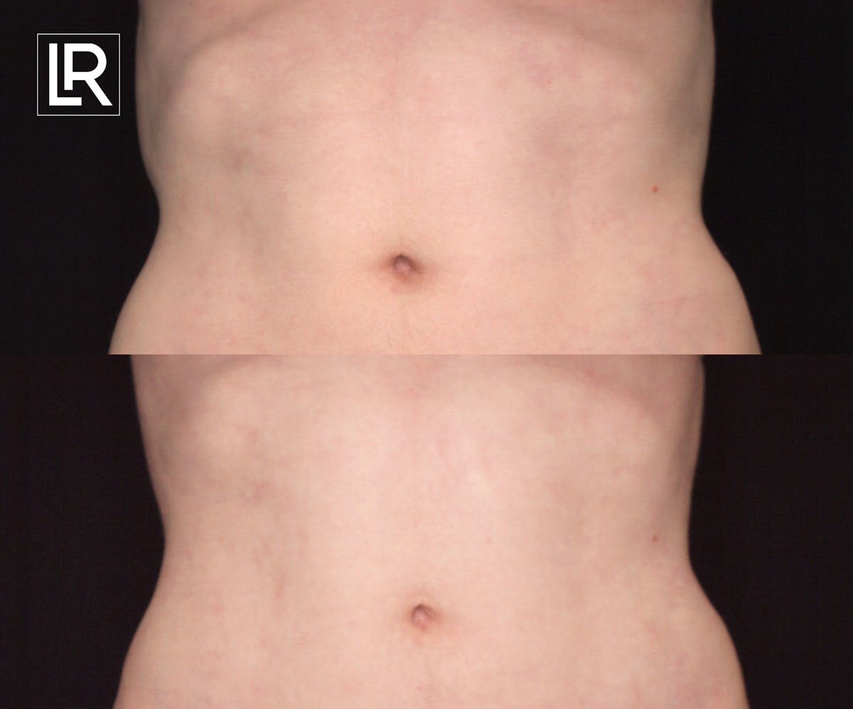 Rib Remodeling Before & After Gallery - Patient 172296 - Image 1