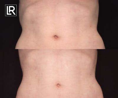 Rib Remodeling Before & After Gallery - Patient 172296 - Image 1