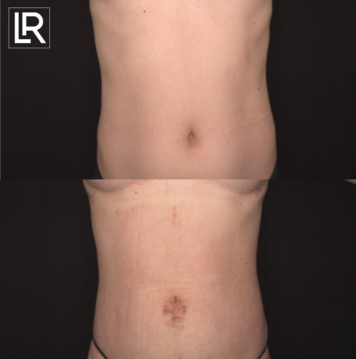 Rib Remodeling Before & After Gallery - Patient 152062 - Image 1