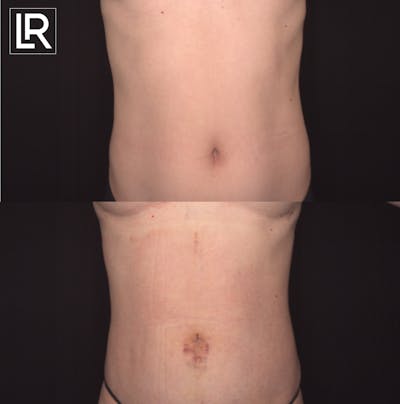 Rib Remodeling Before & After Gallery - Patient 152062 - Image 1