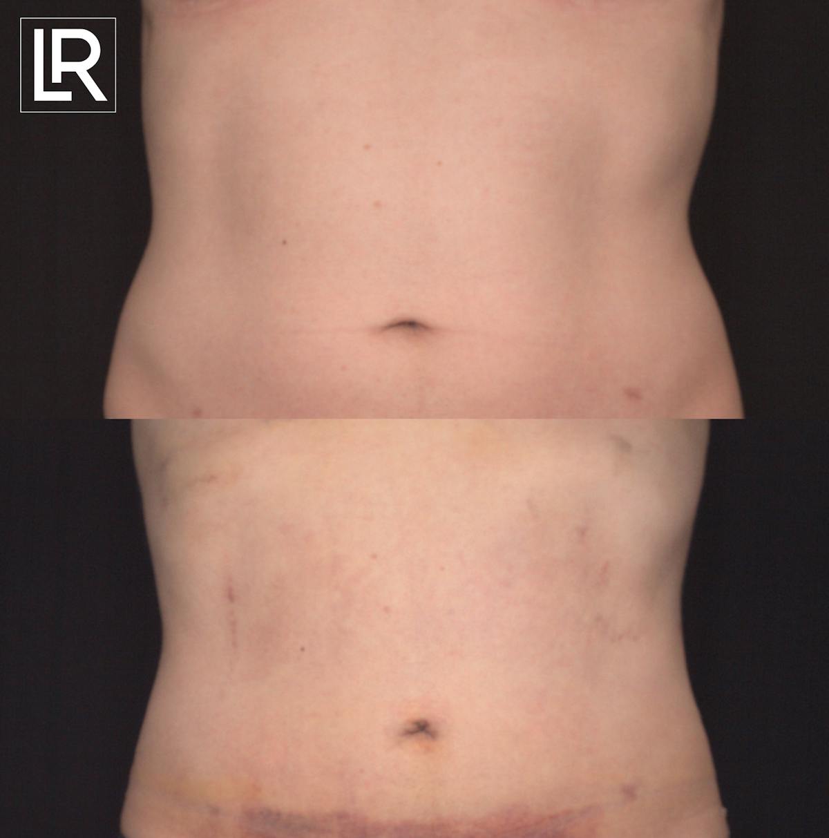 Rib Remodeling Before & After Gallery - Patient 144199 - Image 1