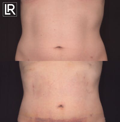Rib Remodeling Before & After Gallery - Patient 144199 - Image 1