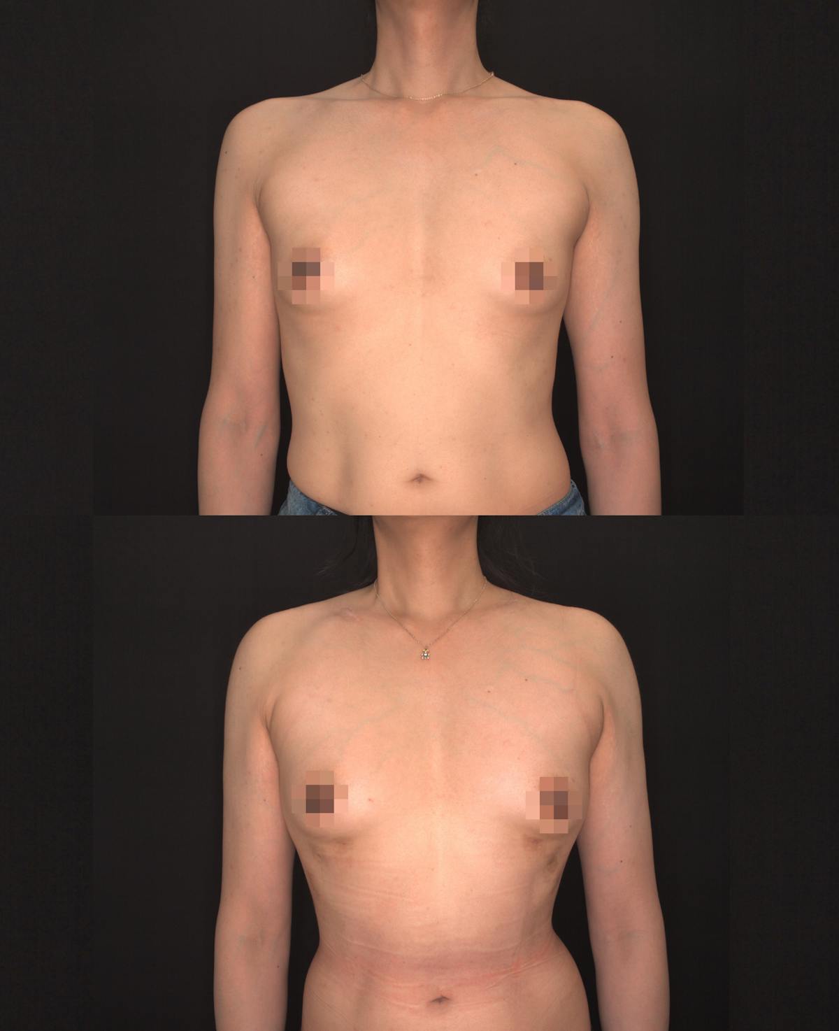 Rib Remodeling Before & After Gallery - Patient 270557 - Image 1