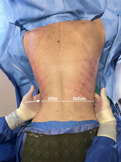 Rib Remodeling Before & After Gallery - Patient 169596 - Image 1