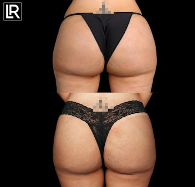 Buttocks Lift Before & After Gallery - Patient 351495 - Image 1