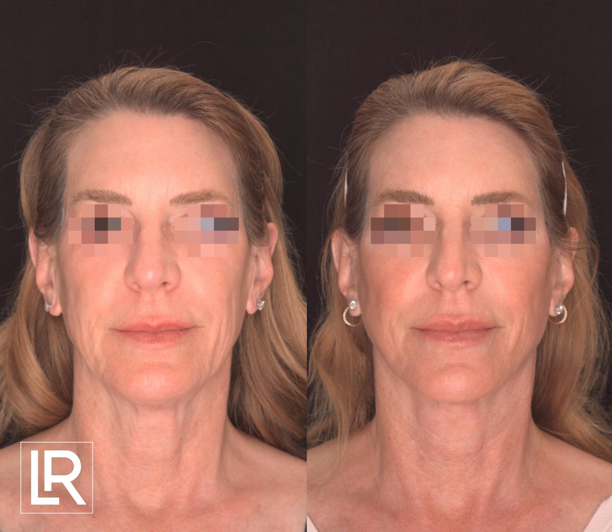 Facelift Female Before & After Gallery - Patient 424489 - Image 1