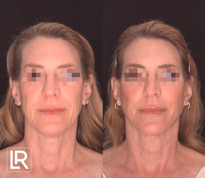 Facelift Female Before & After Gallery - Patient 424489 - Image 1