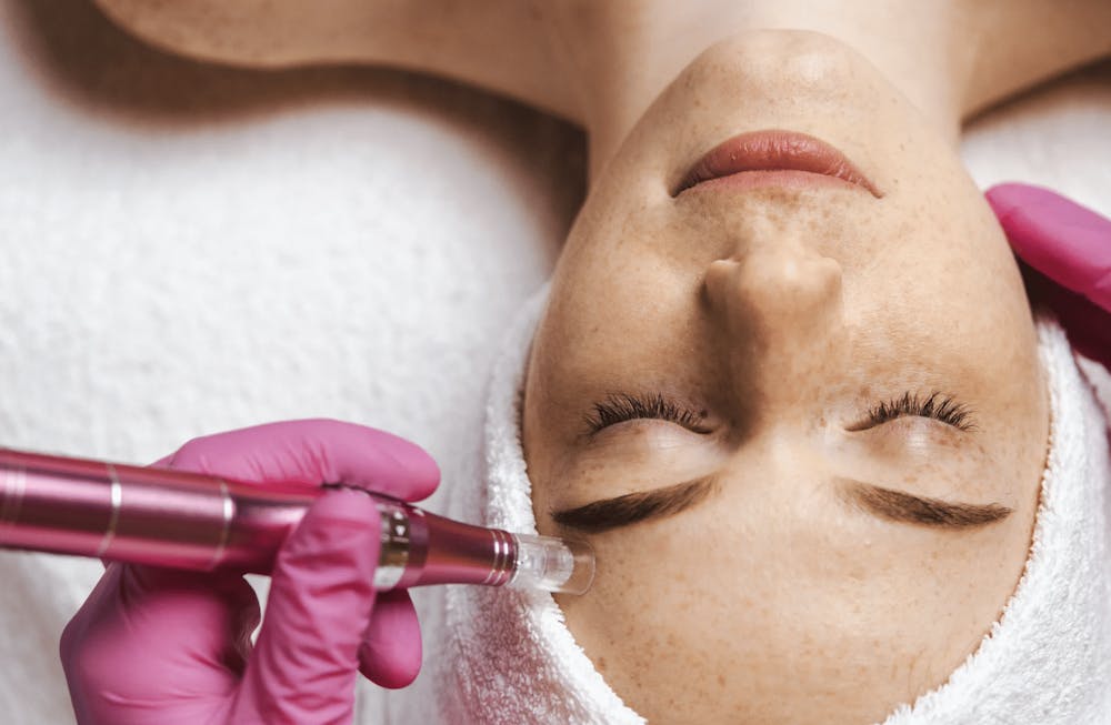 woman getting a microneedling treatment