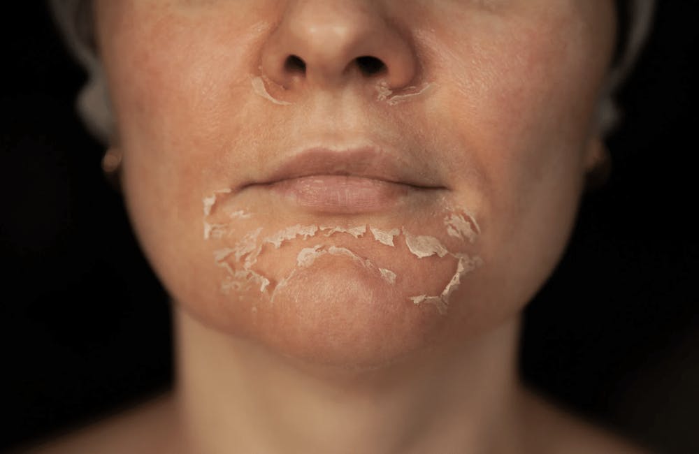 person with their skin peeling