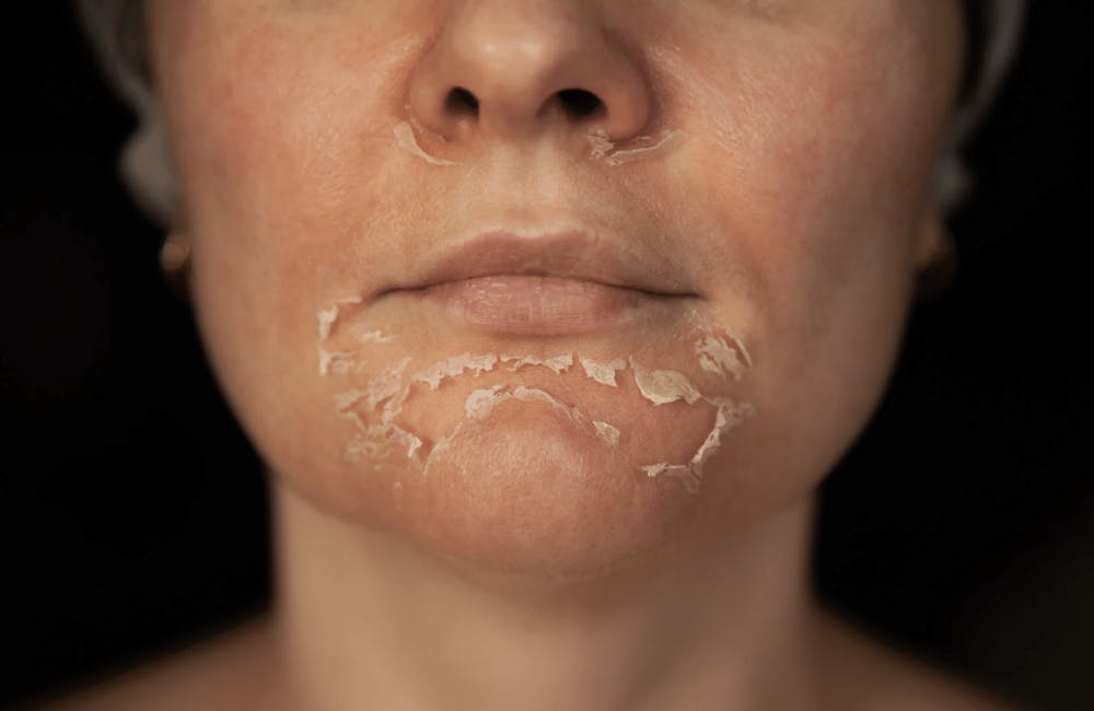 person with their skin peeling