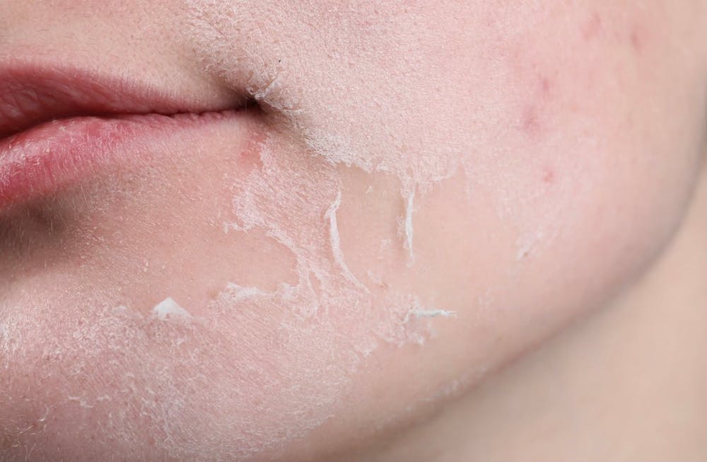 woman's skin peeling