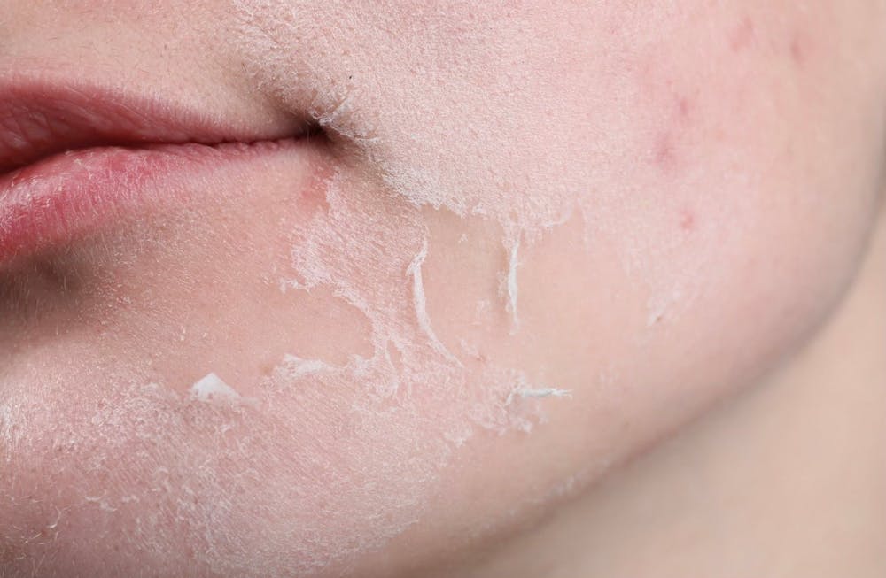 woman's skin peeling