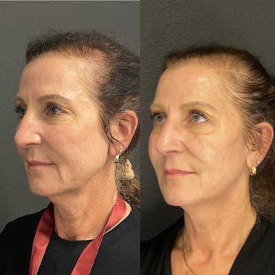 Combination Before & After Gallery - Patient 376192 - Image 1