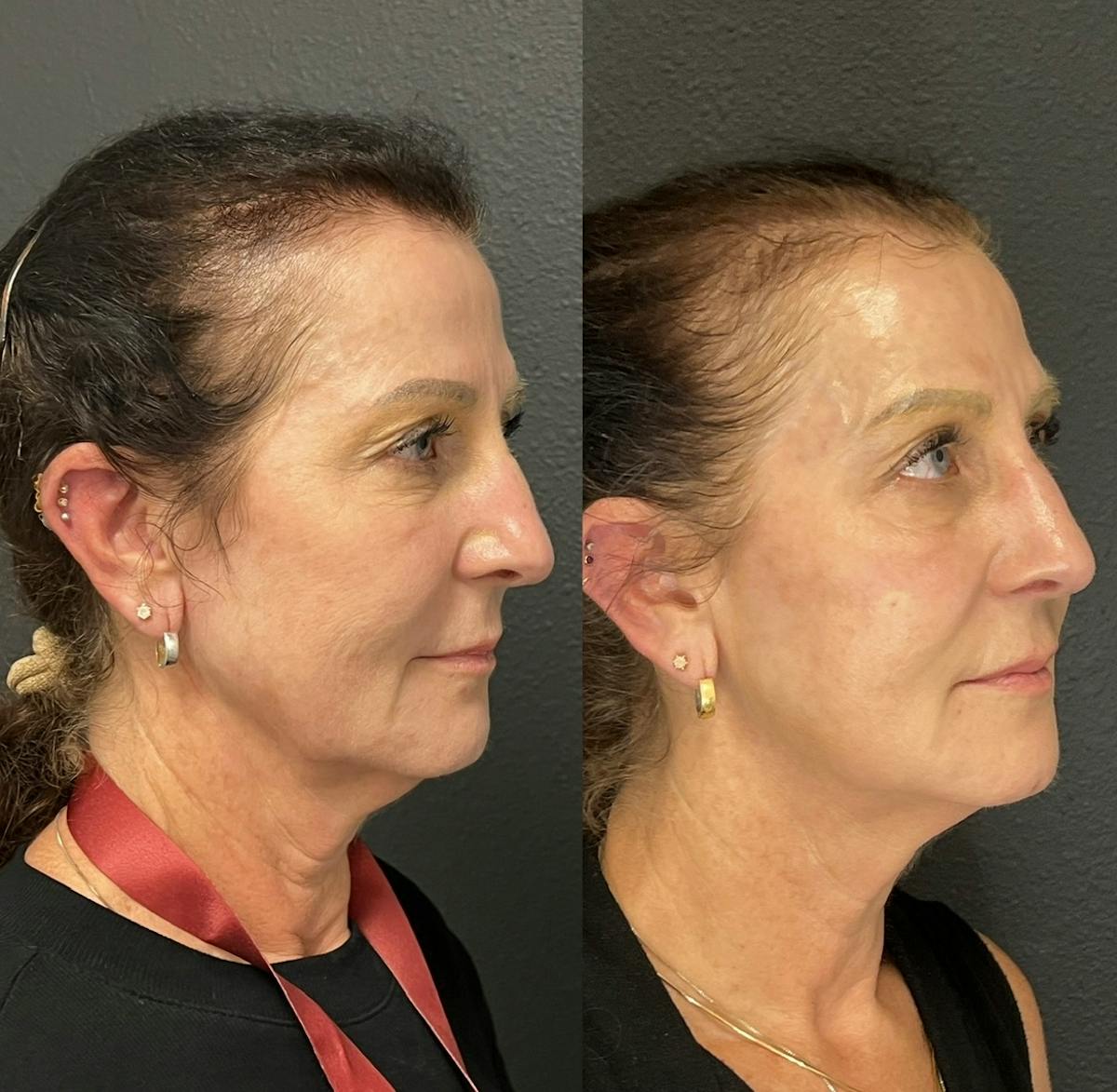 Combination Before & After Gallery - Patient 376192 - Image 2