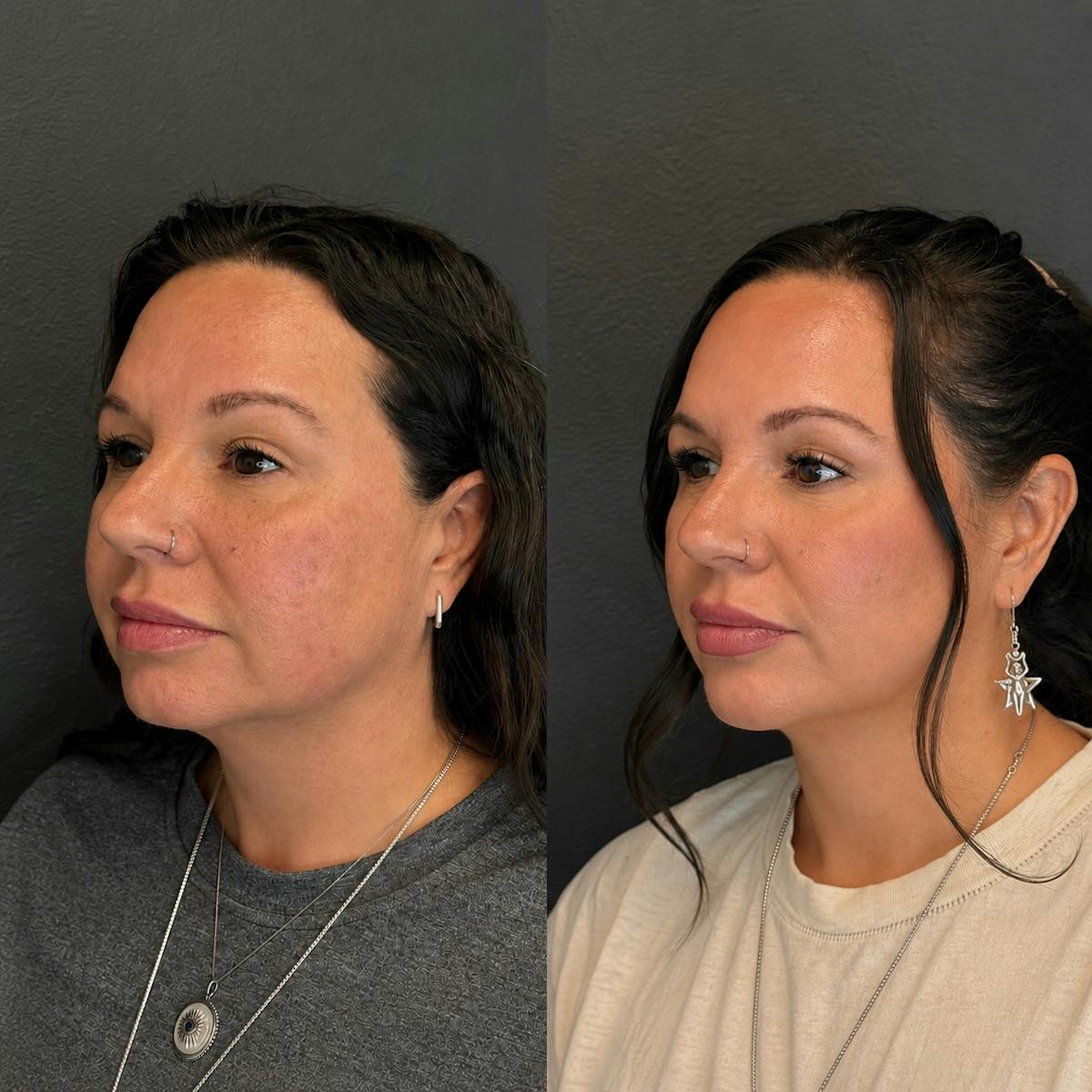 Combination Before & After Gallery - Patient 506608 - Image 1